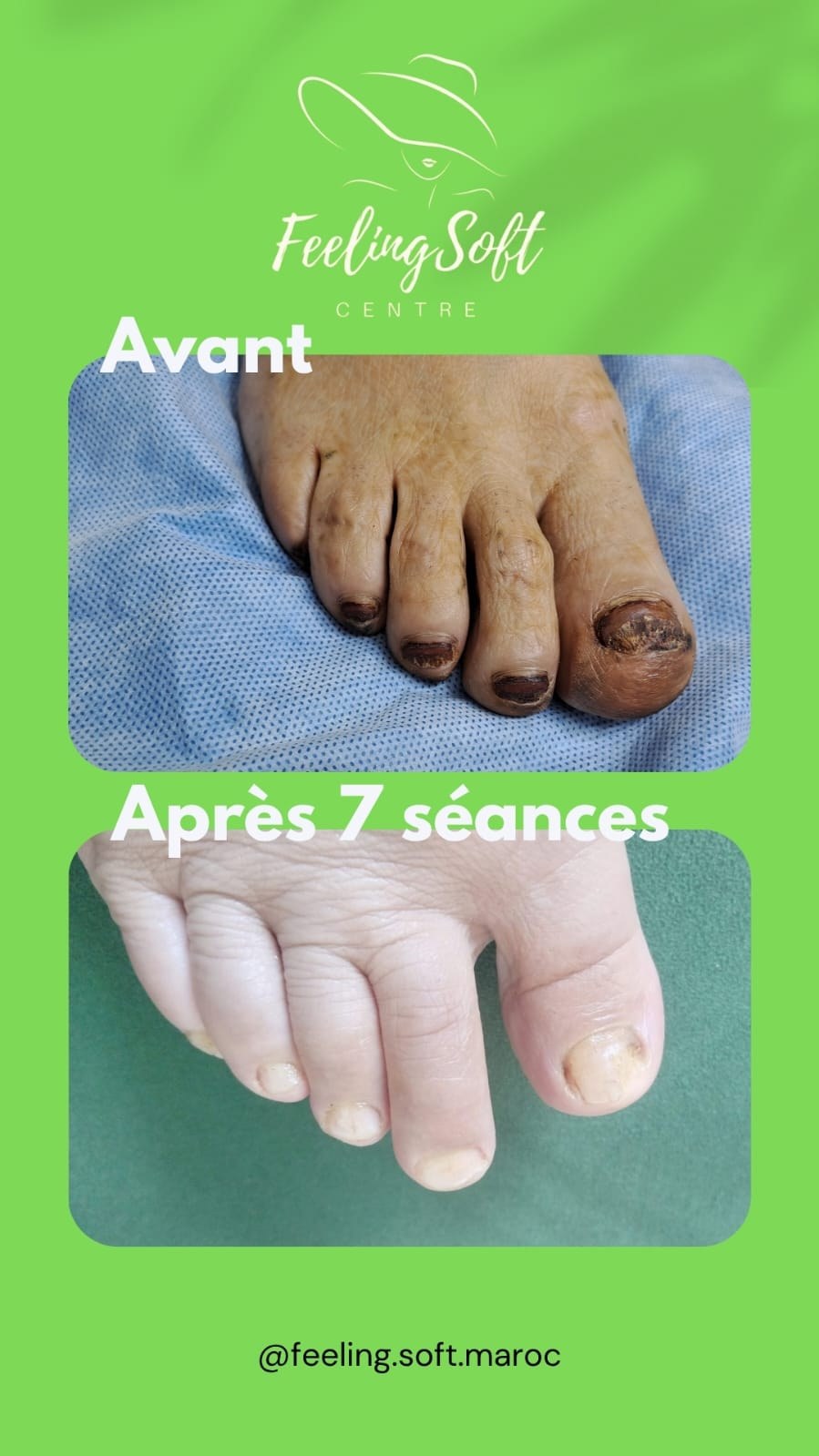 Avant après traitement mycose Feeling Soft