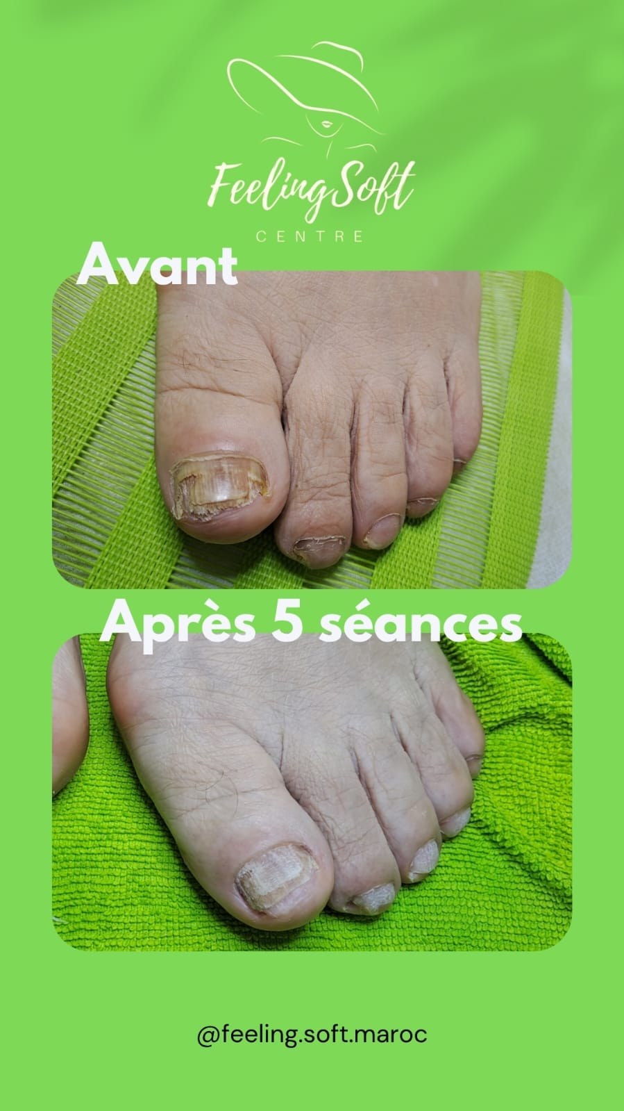 Traitement champignons ongles Casablanca