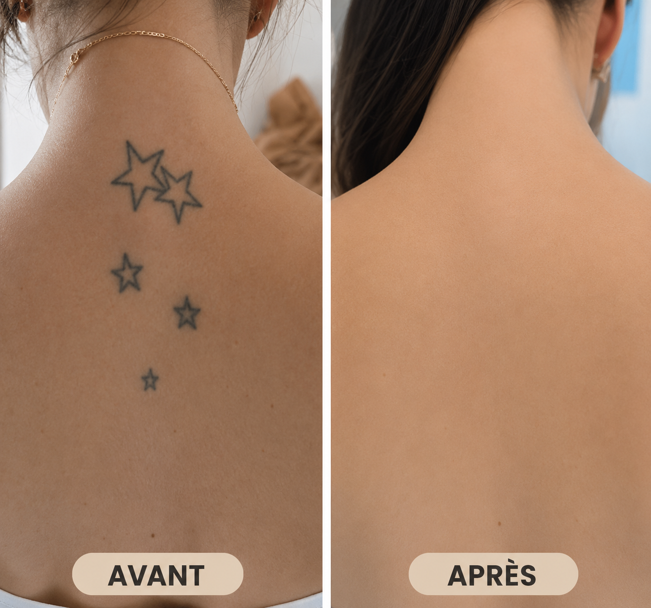 Détatouage au laser avant après