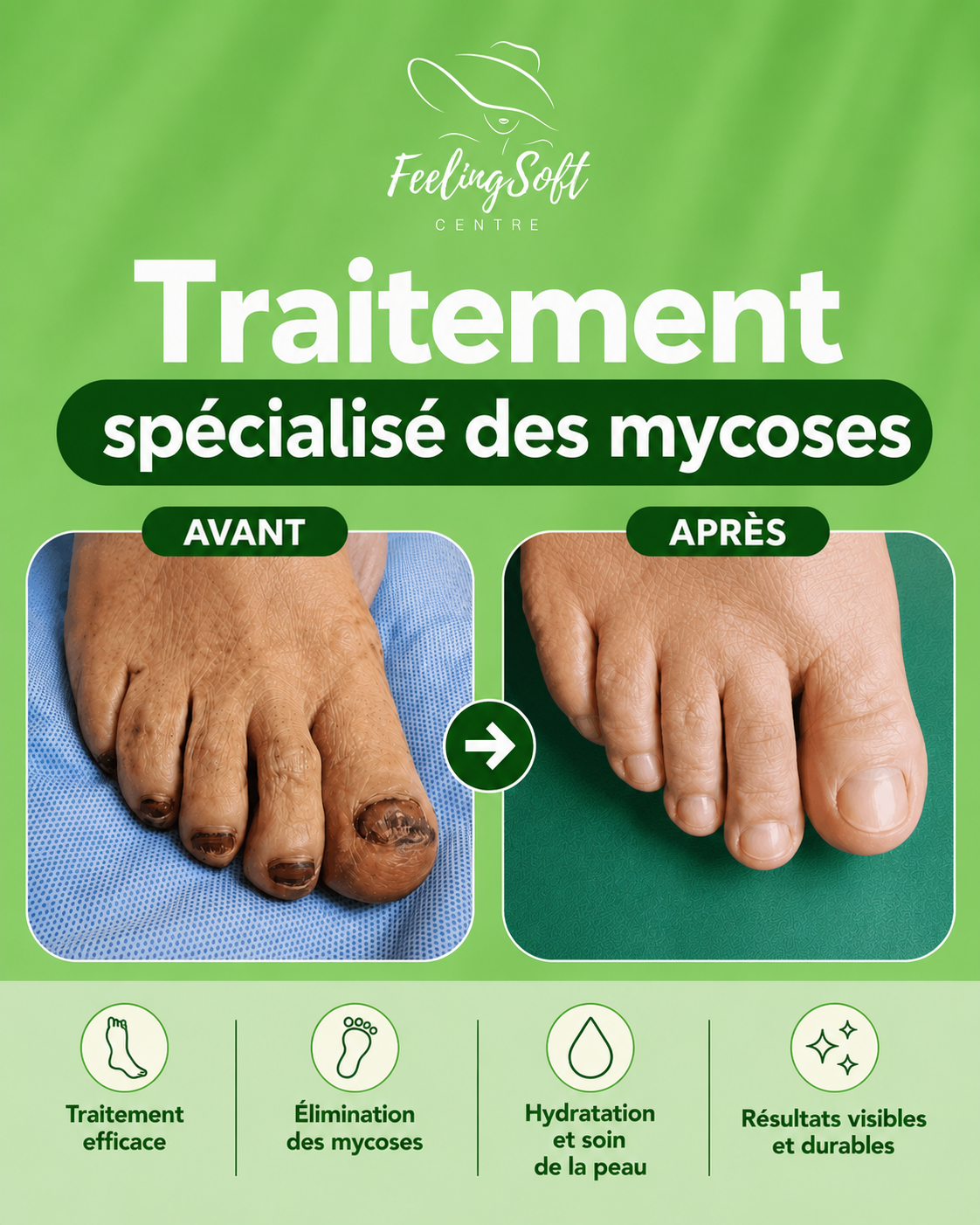 Traitement spécialisé des mycoses à Casablanca